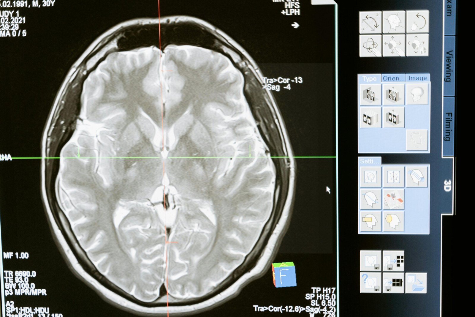 Medical Illustration showing Narcolepsy anatomy and affected areas